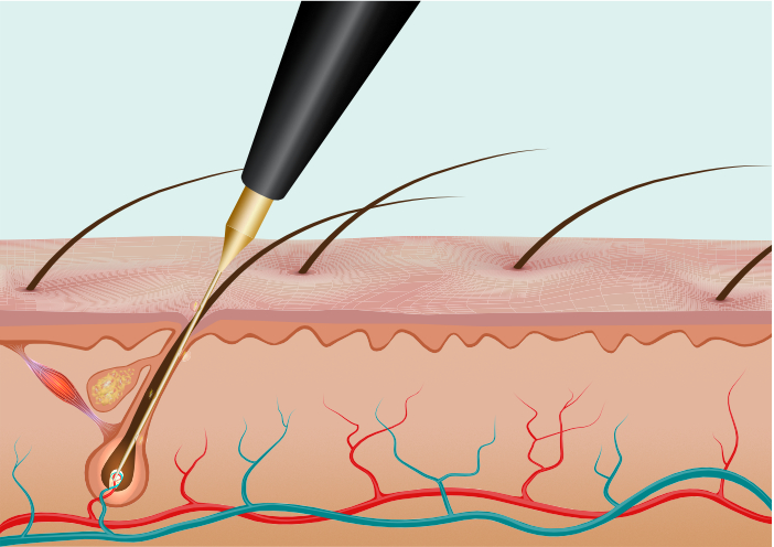 Einführen einer feinen Sonde in ein Haarfollikel